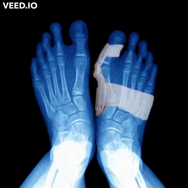 جهاز تقويم وتصحيح عظمة القدم - التقنيه المتطورة - Makfool