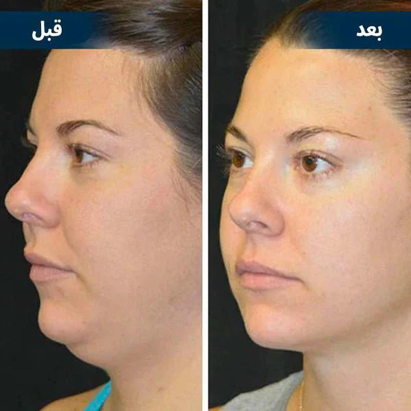 جهاز التجميل ومنع الشخير المعجزة اثناء النوم - Makfool